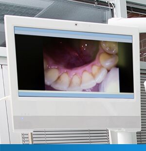 screen showing image from an intraoral camera